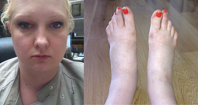 Po lewej - opuchnięta twarz Diany, po prawej zdjęcie bardzo opuchniętych stóp